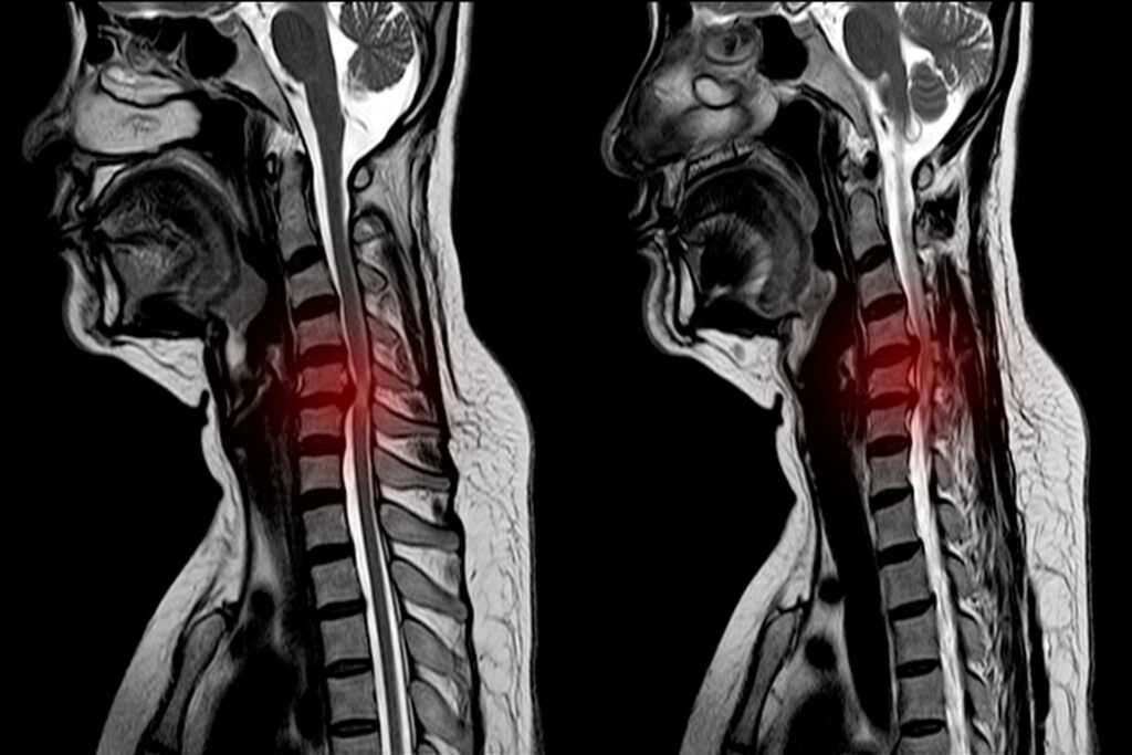 Diagnosis of a Spinal Cord Injury - Texas Truck Accident Attorney